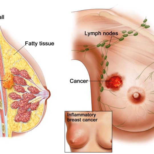 Tầm soát ung thư nữ giới